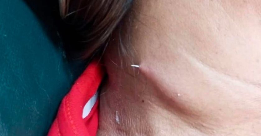 RIBLJA KOST JOJ PROBILA VRAT: Tajlanđanka živjela s bolom 14 dana dok joj kost nije izašla kroz kožu!