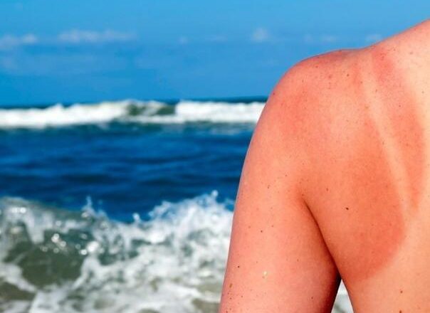 Griješite li i vi? Ovo nikako ne nanosite na kožu odmah nakon sunčanja!