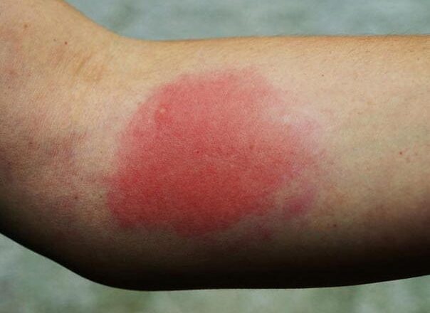 Ubod ose može biti smrtonosan: Kako prepoznati opasne reakcije i reagovati na vrijeme