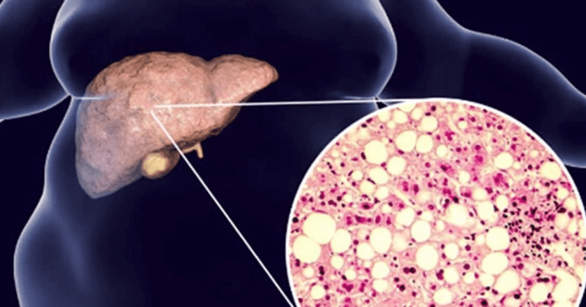 Bolje od surutke: Samo 50g ove namirnice dnevno čisti jetru i izbacuje toksine