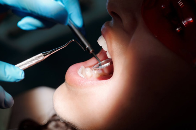 Djevojka umrla nakon vađenja umnjaka u Srbiji: Tužilaštvo hitno naložilo obdukciju