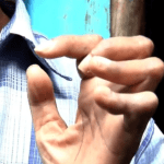 Ima li rizika od širenja gube u Bosni i Hercegovini?