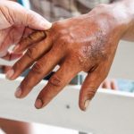 Potvrđen slučaj gube u Hrvatskoj