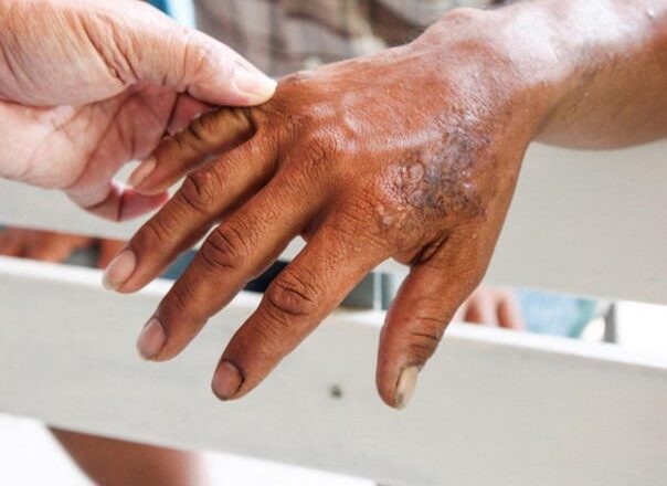 Potvrđen slučaj gube u Hrvatskoj