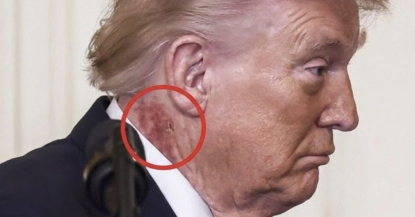 Širi se fotografija crvene mrlje na vratu Donalda Trumpa, oglasila se Bijela kuća